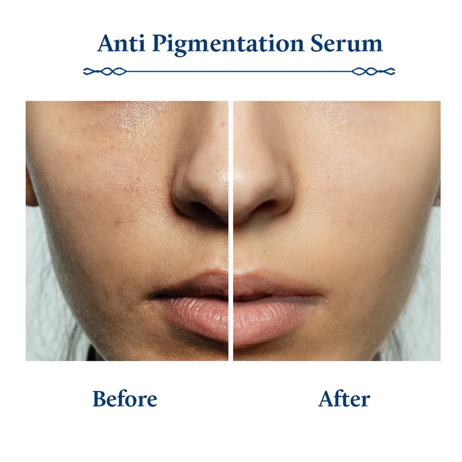 Skin Treatment for Hyper Pigmentation, Clearer Skin, Kojic Acid Serum, Rice Water and Mushroom